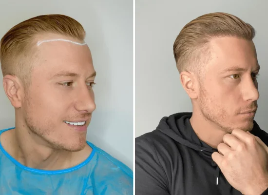 3-months-after-hair-transplant.png